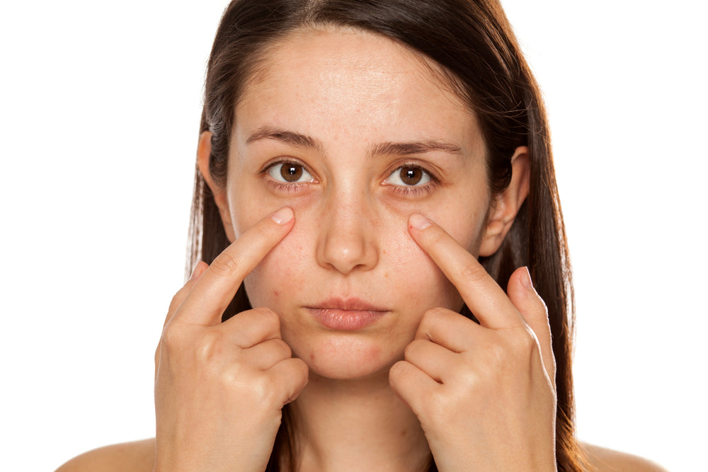 DARK CIRCLES UNDER THE EYES? 3 ESSENTIAL TIPS ON HOW TO REMOVE THEM